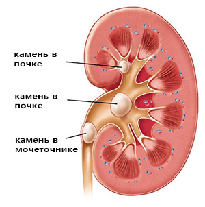 Раздробить камни в почках челябинск