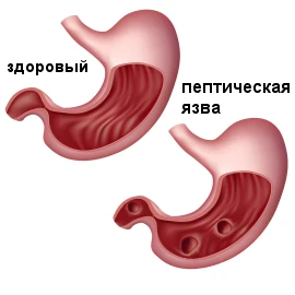 Пептическая язва