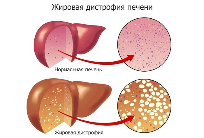 жировая дистрофия печени