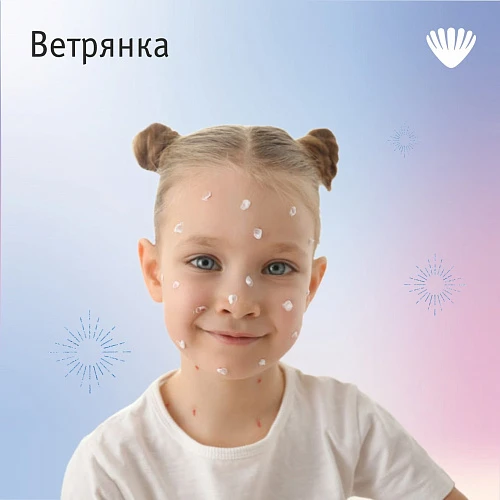 Три мифа о ветрянке