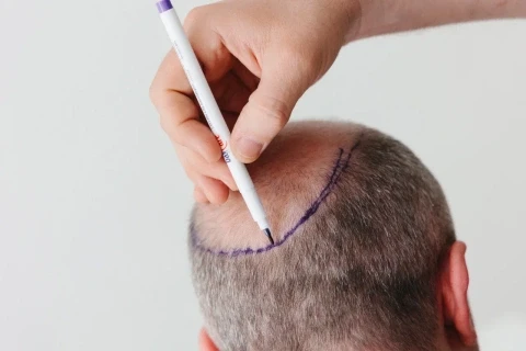 Бесплатный прием пластического хирурга по пересадке волос — фото 3