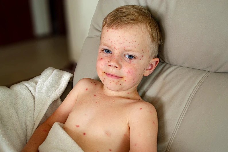 Чем опасна корь