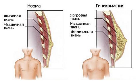 гинекомастия