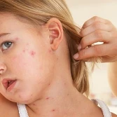 Чем опасна корь