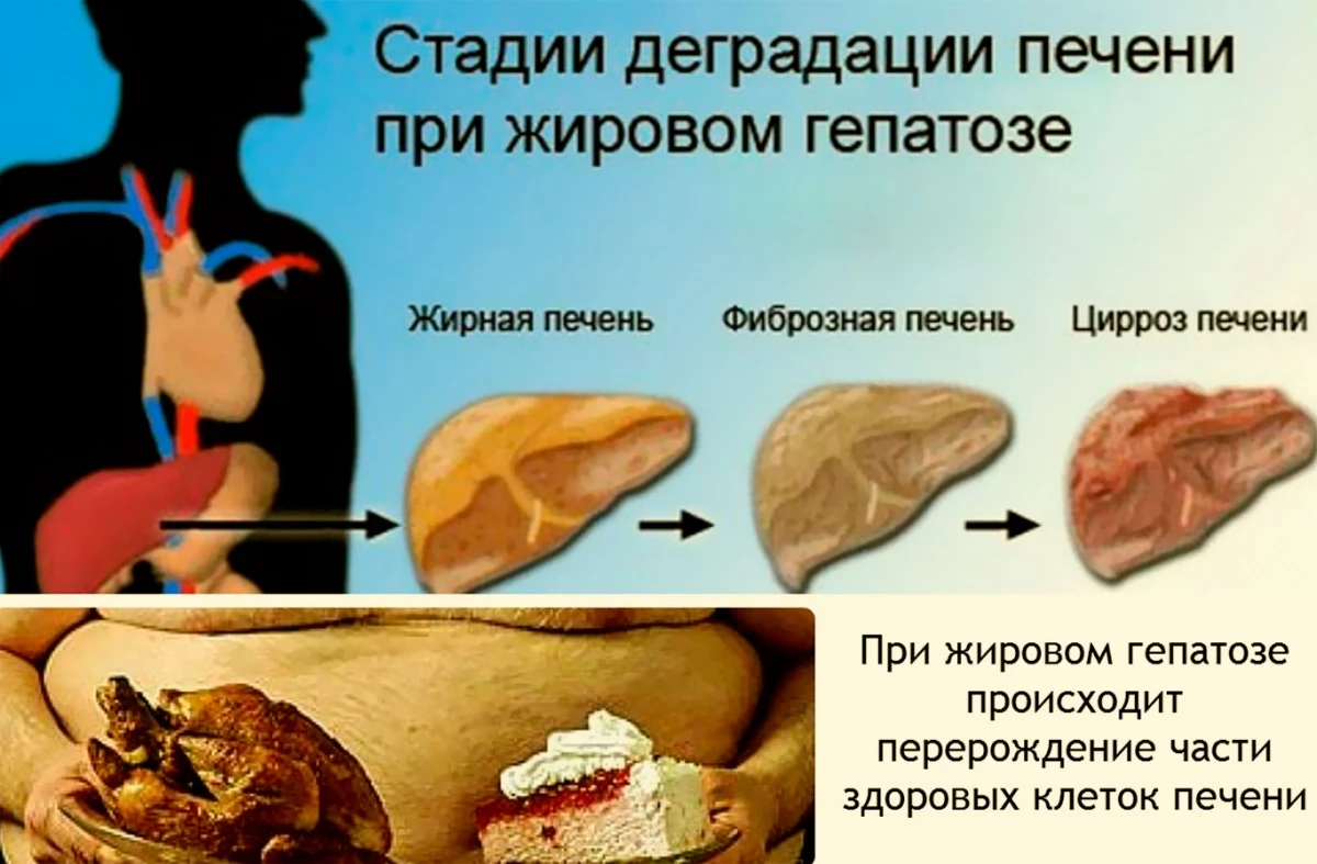 Причины и симптомы фиброза печени. Лечение фиброза печени степеней